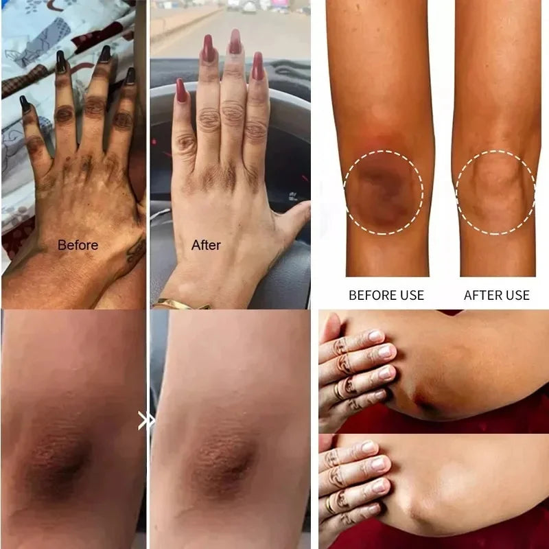 Skin Brightening Cream for Women Private Parts Lightening Cream Underarm Thigh Dark Bleach Serum Remove Melanin Brighten Cream